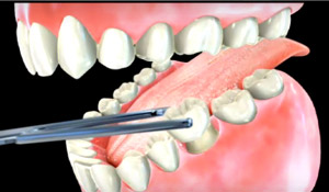 crowns - calgary dentist crowns - calgary dentist