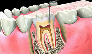 root canal treatment - calgary dentist