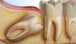 wisdom teeth exstraction - calgary dentist